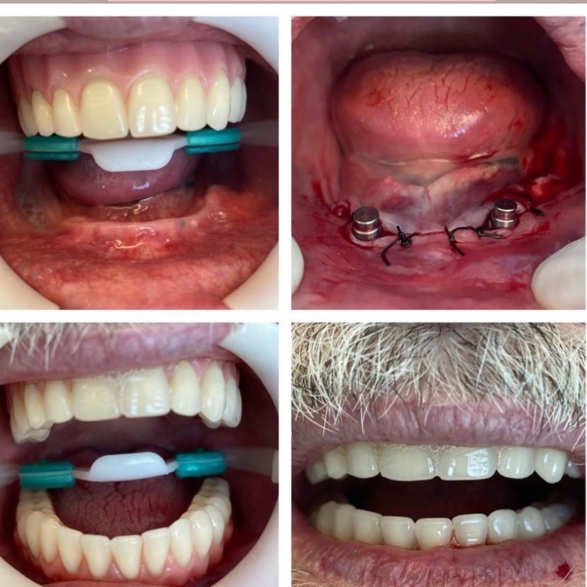 Resultado protocolo sobre implantes