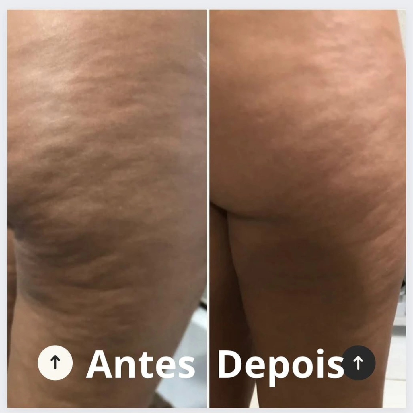 Radiofrequência na Vitória Régia