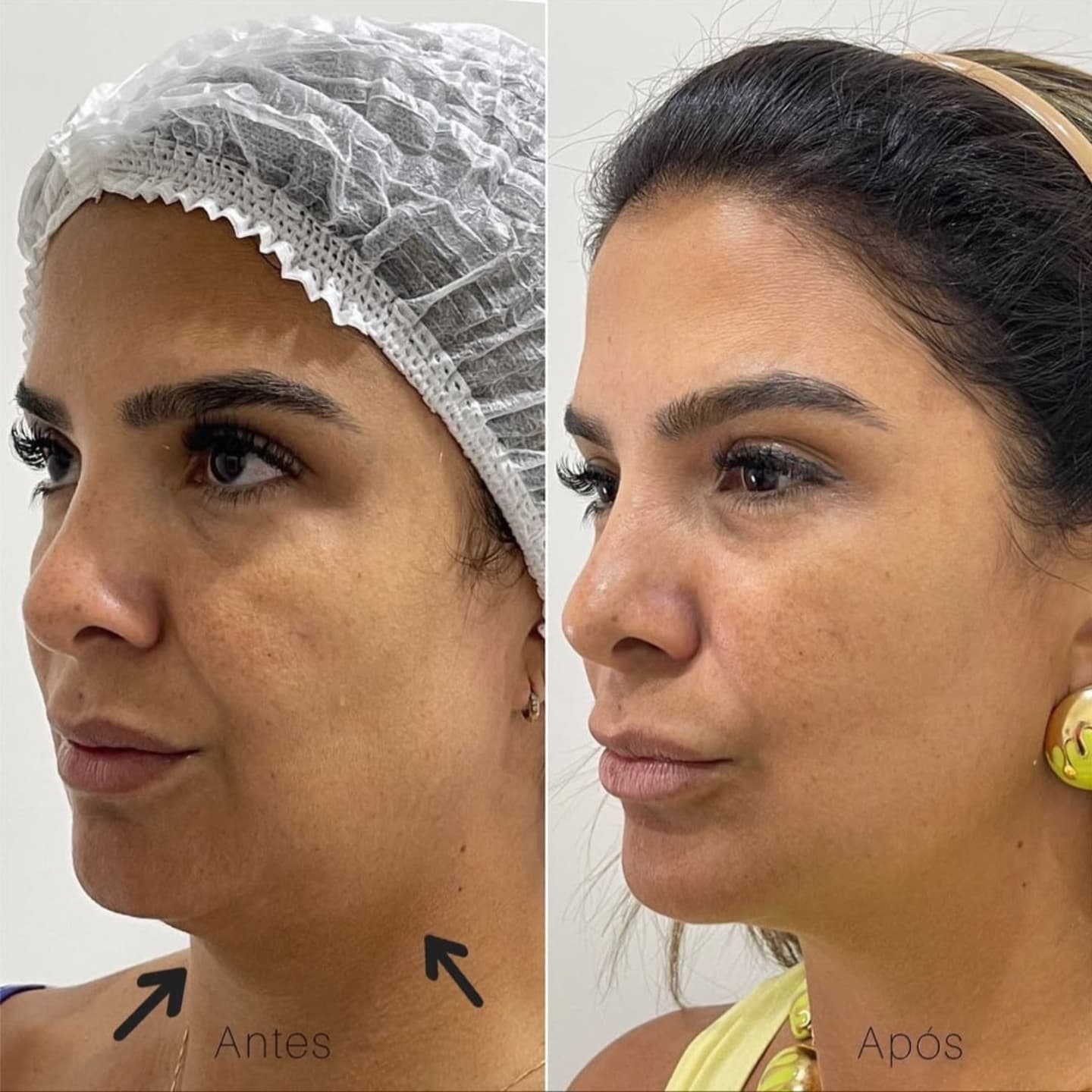 Lipo Enzimática + Radiofrequência na Vitória Régia