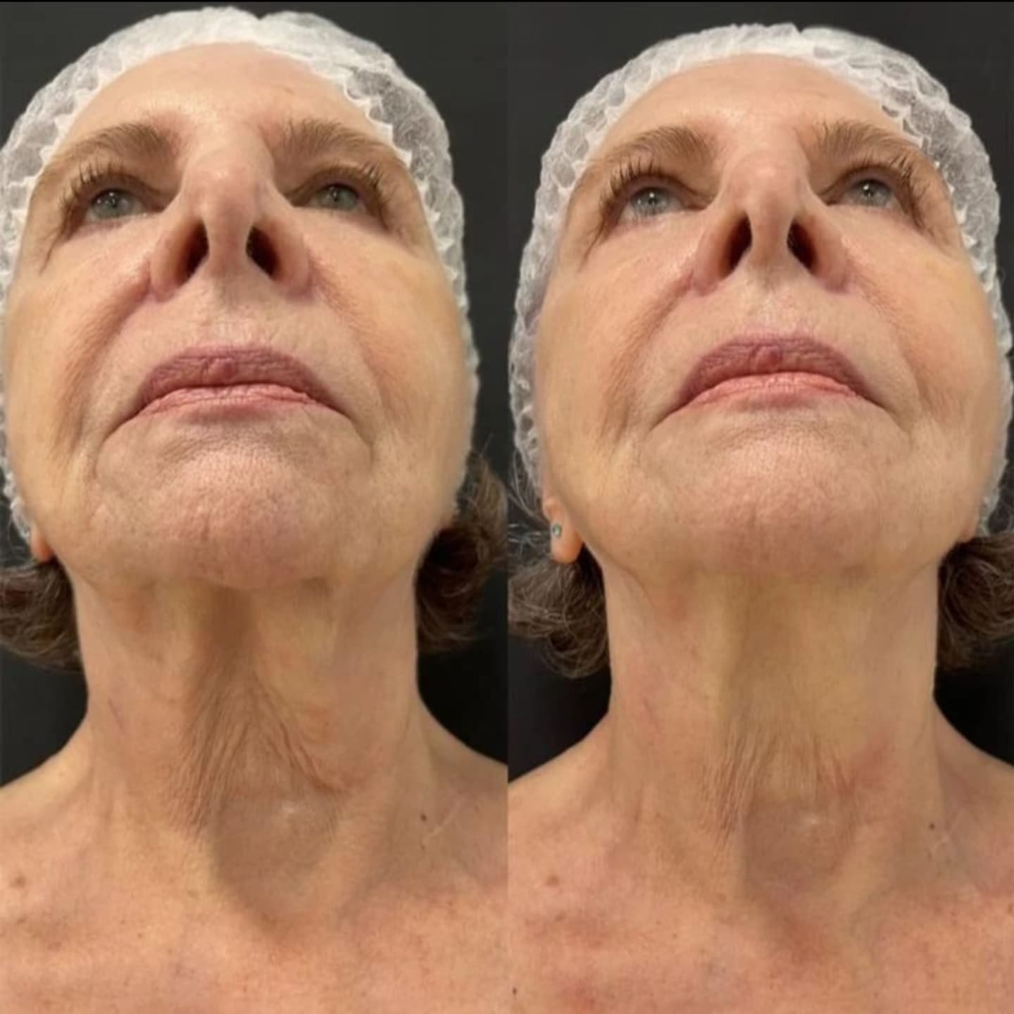 Ultrassom Microfocado + Bioestimulador de Colágeno na Vitória Régia