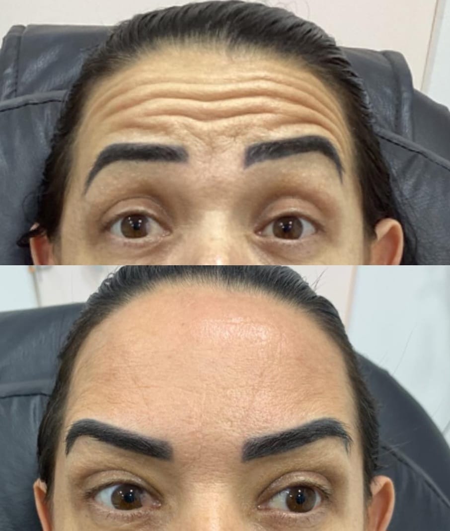 Botox na Vitória Régia