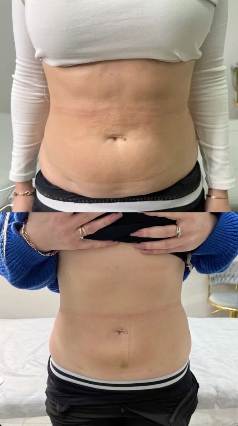 Lipo Enzimática na Vitória Régia