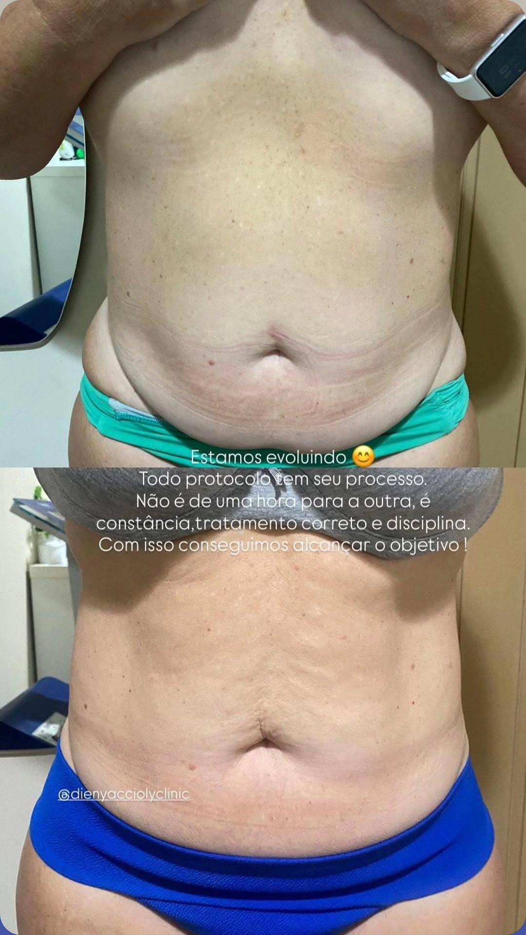 Lipo Enzimática + Radiofrequência na Vitória Régia