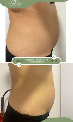 Ultrassom + Radiofrequência na Vitória Régia